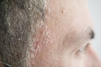 dermite-psoriasis-cuir-chevelu