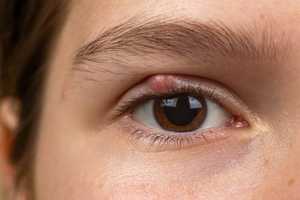 Chalazion : symptômes, causes et traitements