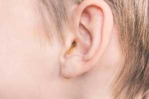 Bouchon d’oreille : symptômes, causes et solutions